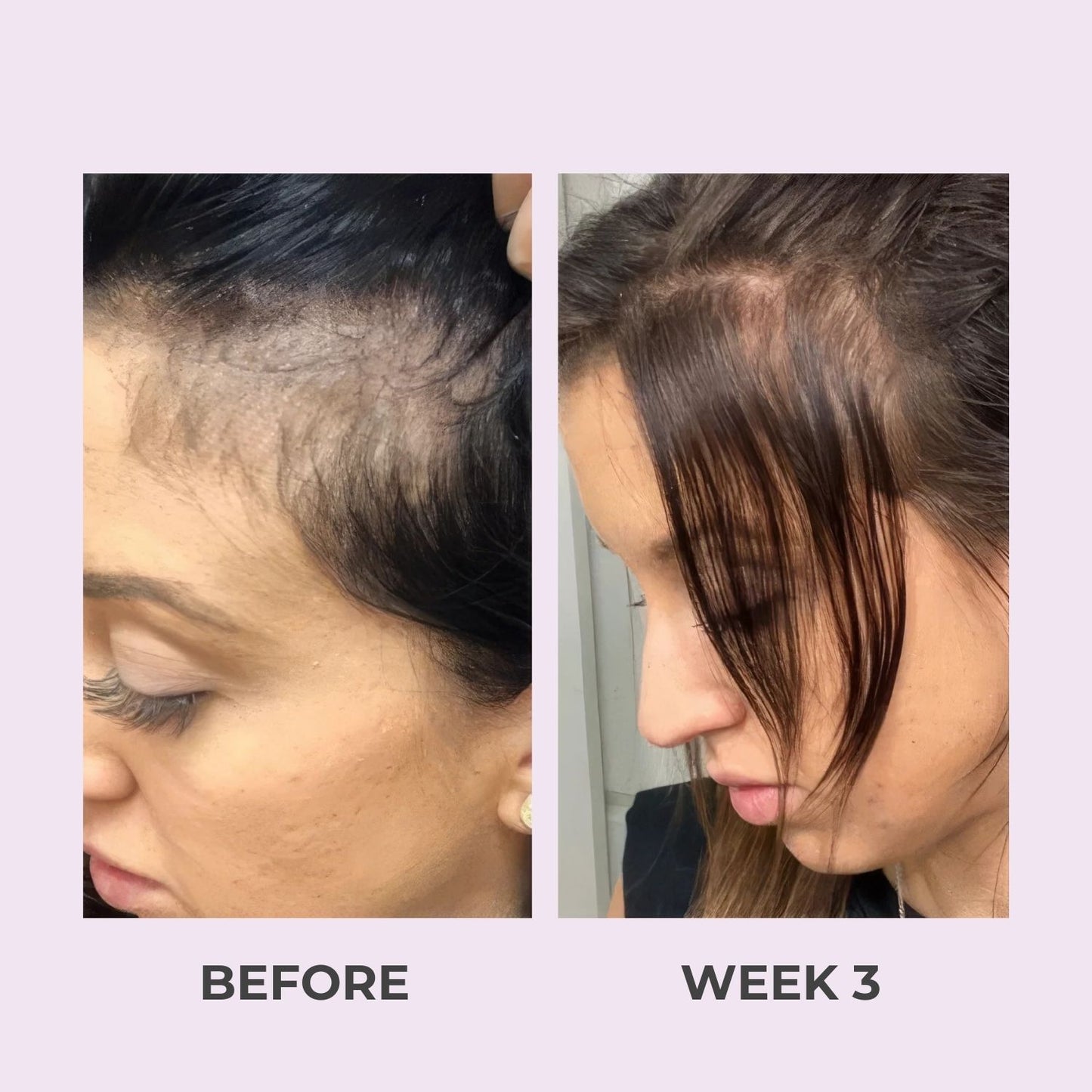 Hair Growth Accelerator Soft Chews